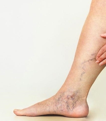 Varislerden Kurtulma Yontemleri